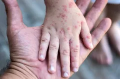 Supera sarampión al COVID-19 en nivel de contagio